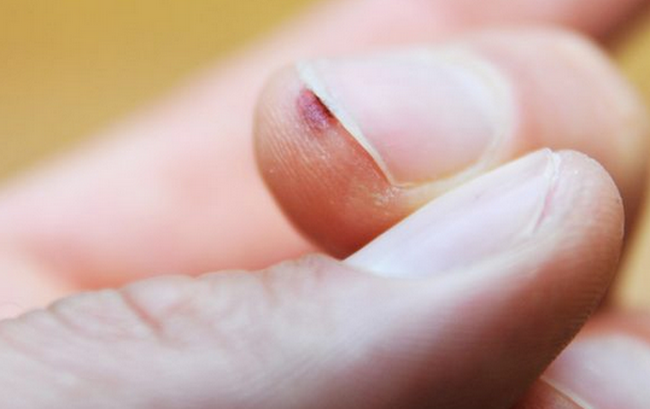 borodavka-pod-nogtem-prichiny-poiavleniia-i-lechenie-9023319