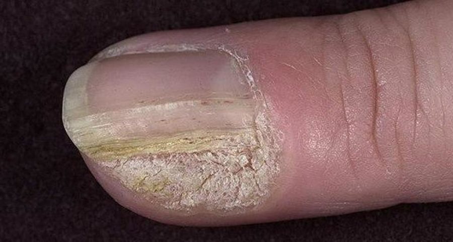 borodavka-pod-nogtem5-900x481-9807835