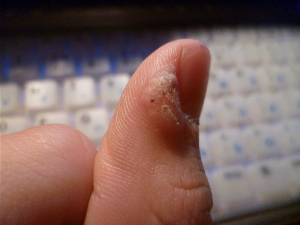 kak-i-chem-mozhno-lechit-narost-na-paltse-ruki-2-1024x768-8522572