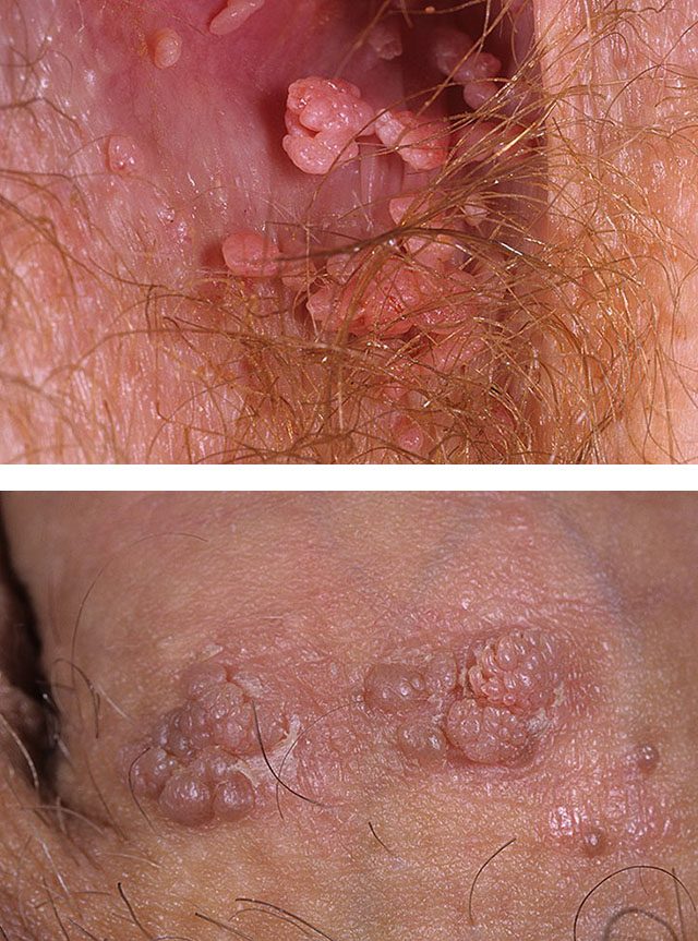 ostrokonechnye-kondilomy-7157672