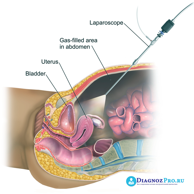 blausen_0602_laparoscopy_02-8709221