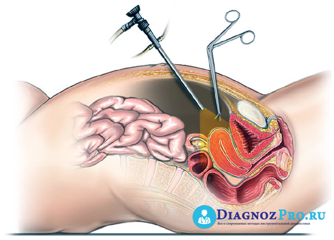 hca-fixed-price-procedure-information-laparoscopy-1471709154-3458852