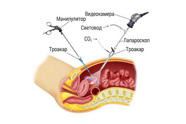 operaciya-laparoskopiya-3758279
