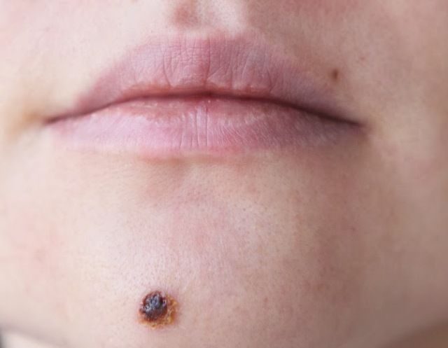 1539523999_rezultat-lecheniya-papillomy-mazyu-viferon-3989270