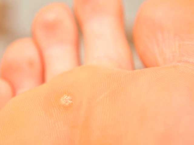 kak-udalit-borodavku-3732570