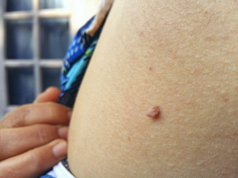 ot-borodavok-5739580