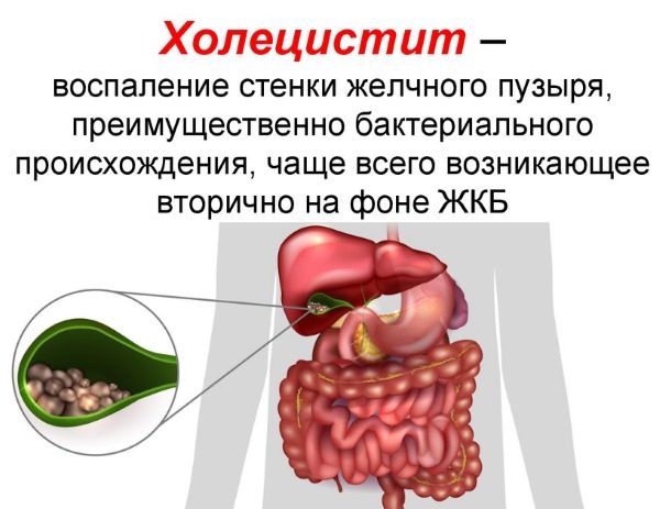 bolezni-zhelchnogo-puzyrya-u-zhenschin-muzhchin-i-detey-simptomy-i-lechenie-5-5880907