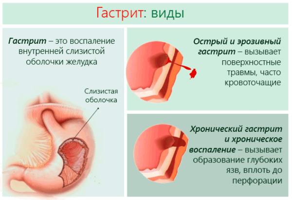 vidy-gastrita-1-600x411-8984312
