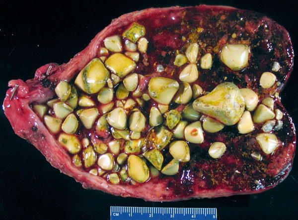 zhelchnye_kamni_v_zhelchnom_puzyre-8480786