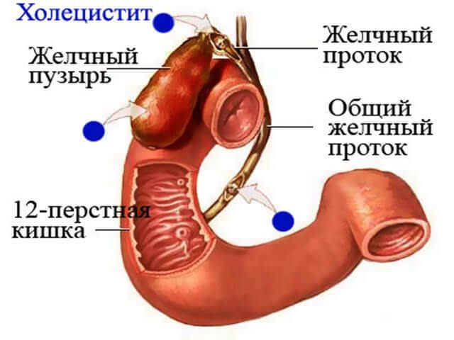 zhelchnyj-puzyr-simptomy-zabolevanija9-5184502