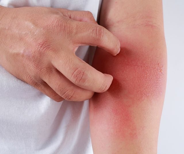 1532002939_zabolevanie-dermatit-9606335