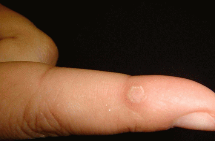 borodavka-na-paltse-e1502302538174-4880641