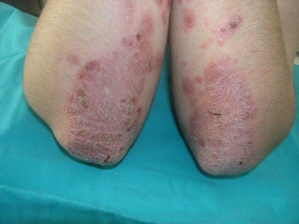 psoriaz-na-loktyah_600x450-2057111