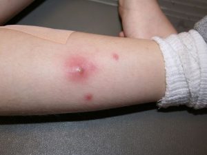 dlya_chego_ispolzovat_maz_vishnevskogo_8-300x225-1520144