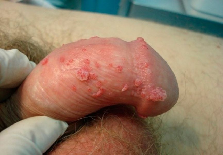 kondilomy-pch-865x600-3128529