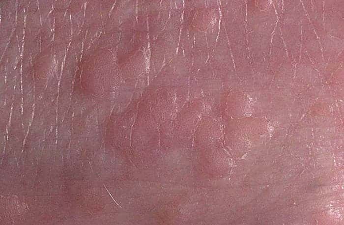 Бородавки у детей на руках лечение комаровский —