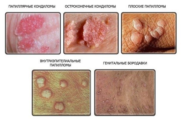 vidy-papillom-cheloveka-2843373
